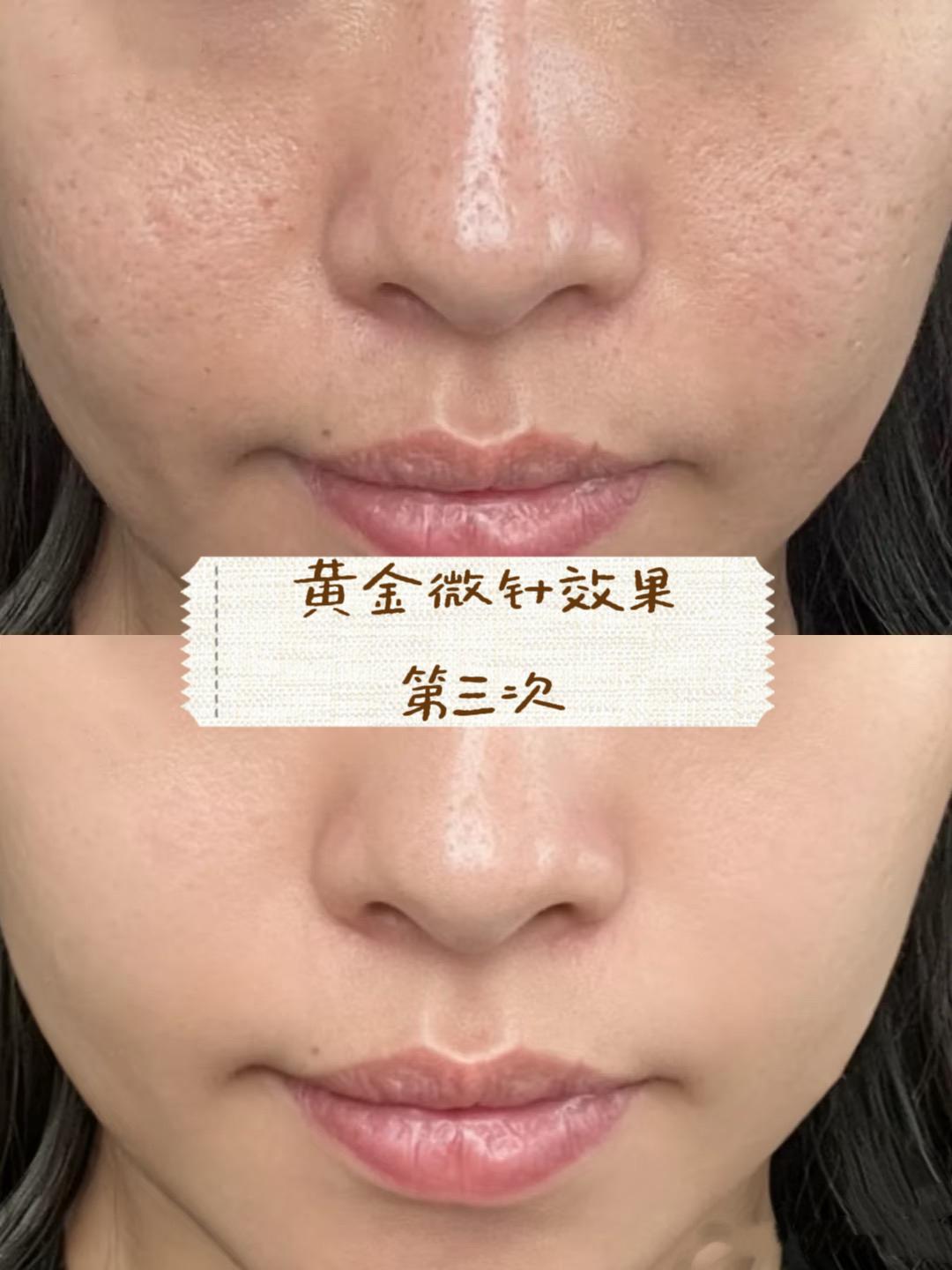 Black Diamond dual-wave gold microneedling case image