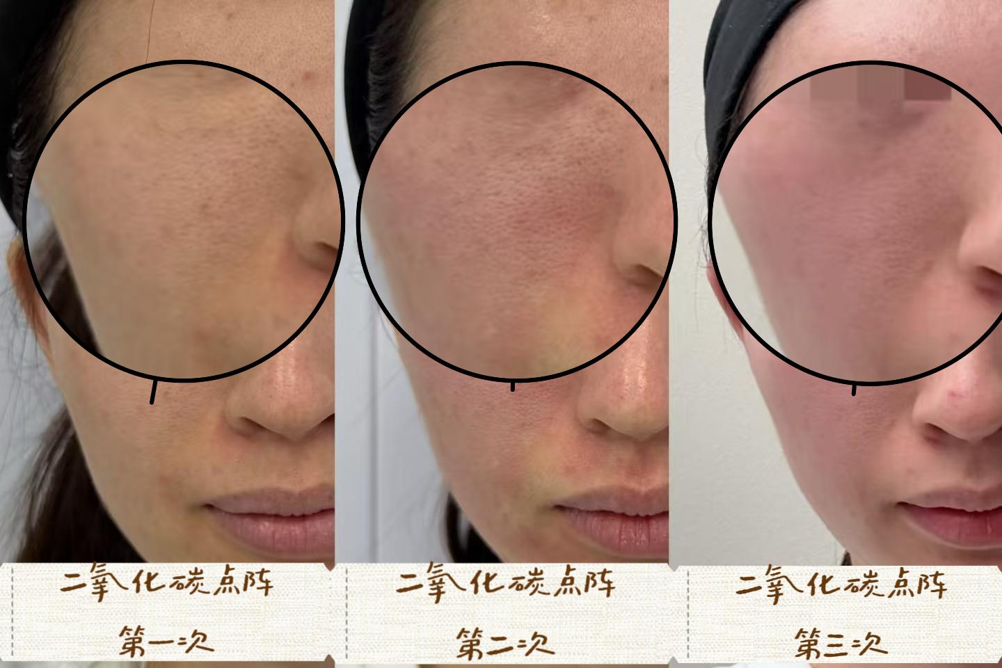 CO2 fractional laser case image