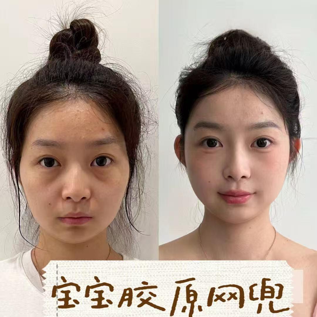 Collagen Net Lift case image