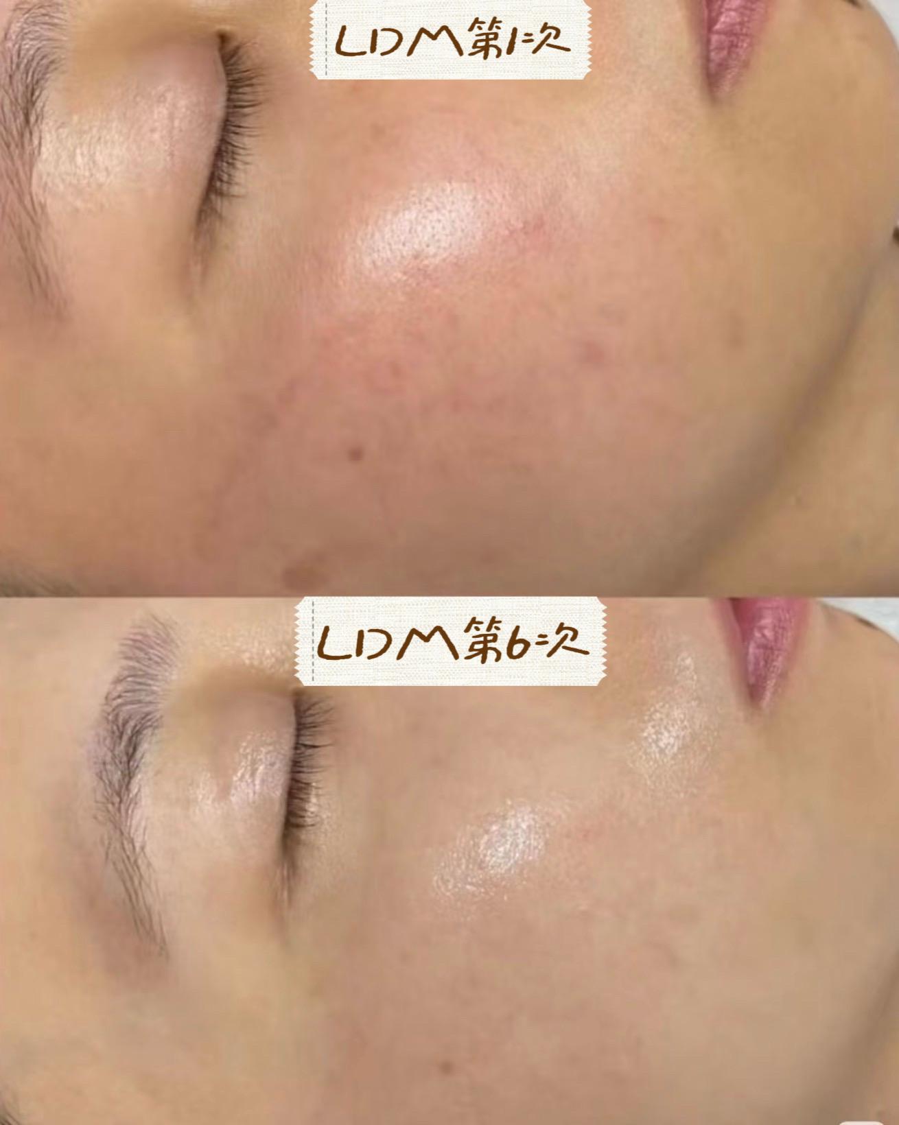 LDM Waterdrop Lift case image