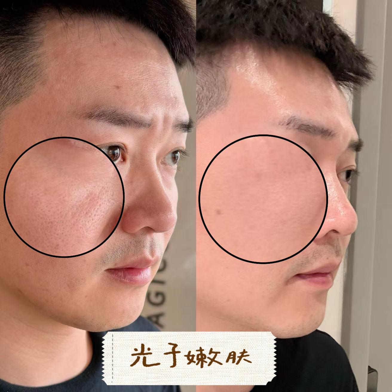 M22 IPL photorejuvenation case image