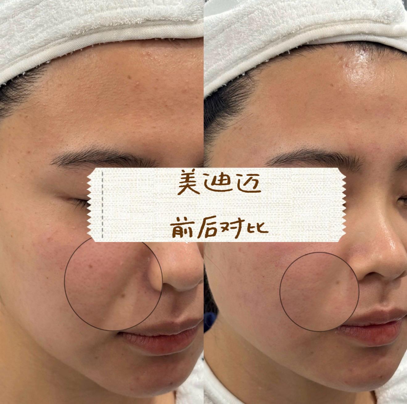 Medima gold microneedling case image