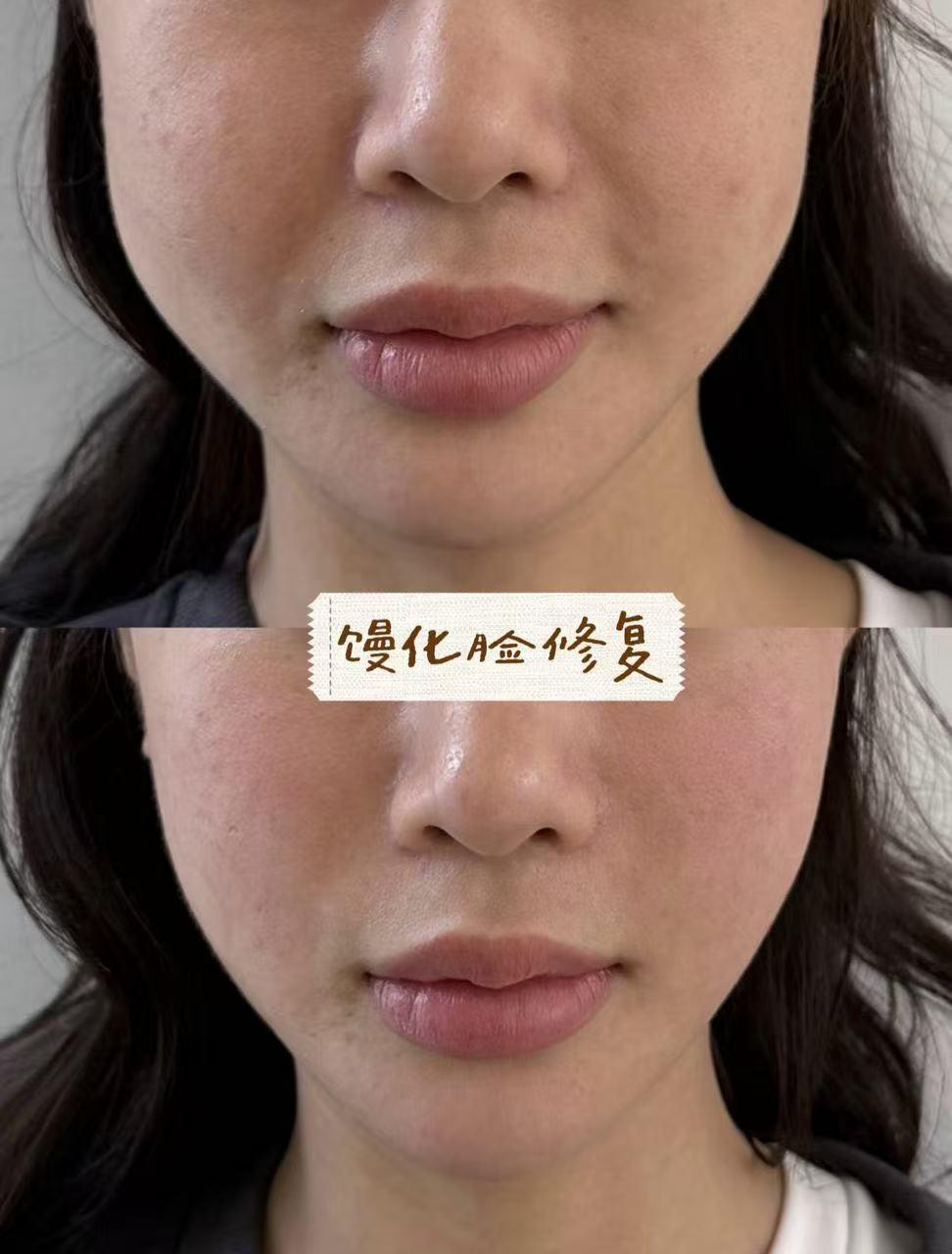 Overfilled Face Correction case image