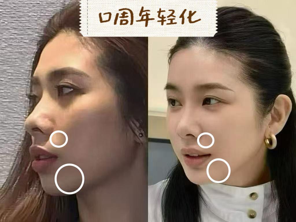 Perioral Rejuvenation case image