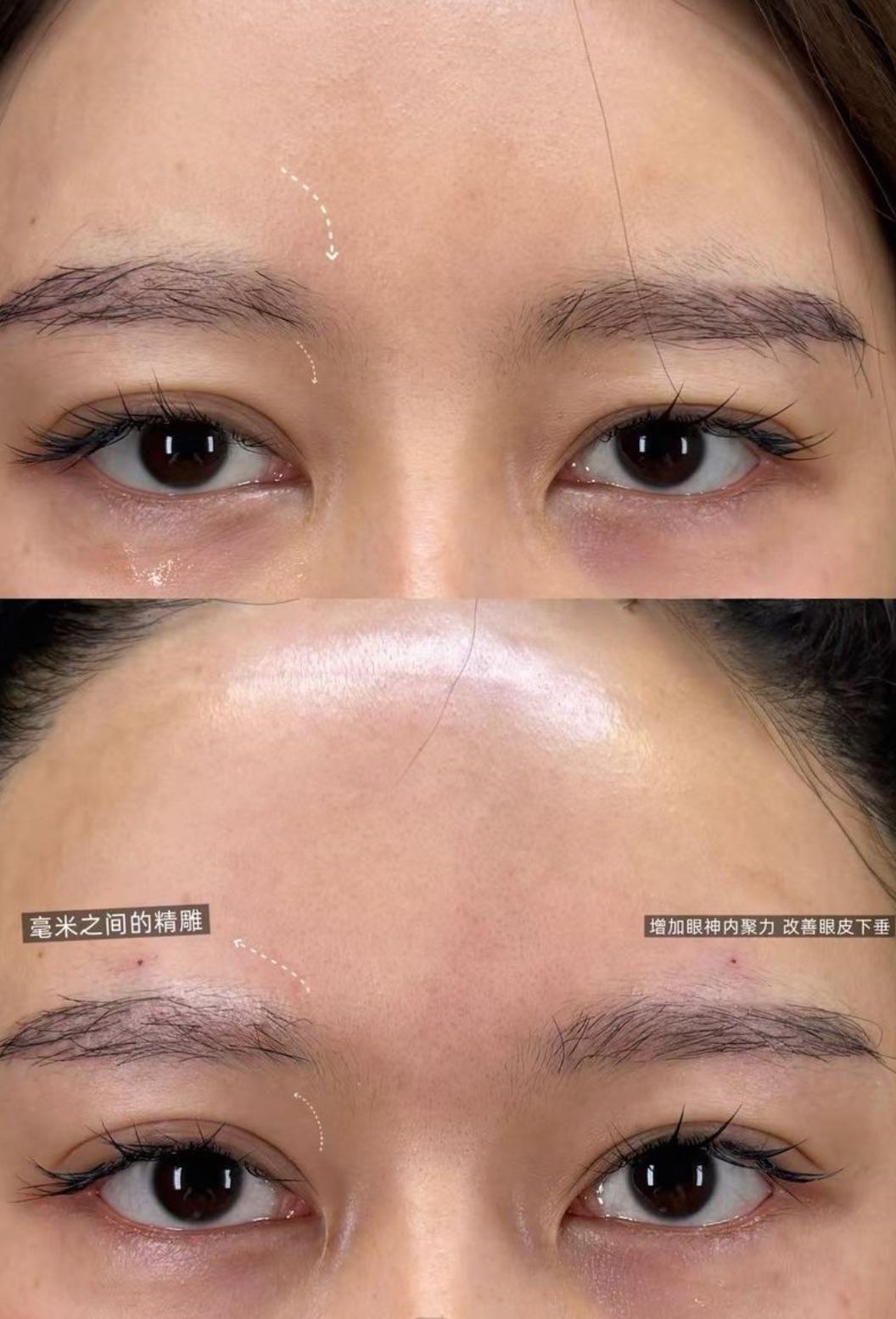 Periorbital Rejuvenation case image