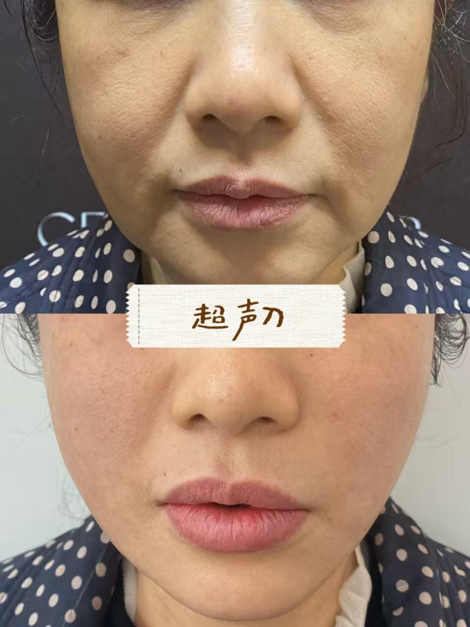 US 2nd Gen Ultherapy case image
